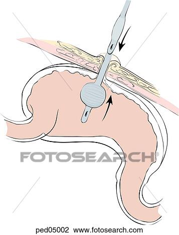 Drawing - Sagittal view of stomach and abdominal wall with preexisting stoma site; deflated Foley catheter is inserted, inflated, then pulled snug to stomach wall.. Fotosearch