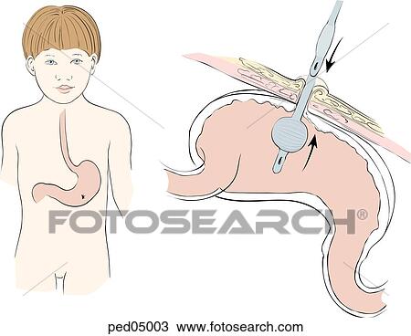 Sagittal view of stomach and abdominal wall with preexisting stoma site; deflated catheter is inserted, inflated, then pulled snug to stomach wall; insert: anterior view of child with location of stomach and site of stoma indicated. View Large Illustration Drawing - Sagittal view of stomach and abdominal wall with preexisting stoma site; deflated catheter is inserted, inflated, then pulled snug to stomach wall; insert: anterior view of child with location of stomach and site of stoma indicated.. Fotosearch