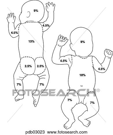 Schematic drawing of infant showing body surface areas as percent of whole; used in calculating burn damage. View Large Illustration Drawing - Schematic drawing of infant showing body surface areas as percent of whole; used in calculating burn damage.. Fotosearch