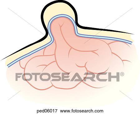 Stock Illustration - Section of abdomen showing an umbilical hernia with the peritoneum pushing into umbilical area.. Fotosearch