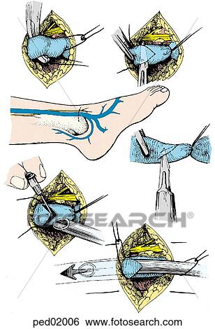 Series of images describe isolation, incision, and tube insertion in a saphenous vein cutdown. View Large Illustration Stock Illustration - Series of images describe isolation, incision, and tube insertion in a saphenous vein cutdown.. Fotosearch