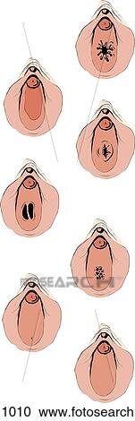 Seven normal variants in hymenal structure are shown and named. View Large Illustration Clipart - Seven normal variants in hymenal structure are shown and named.. Fotosearch