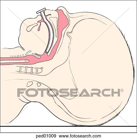 Simple sagittal view of infant head and neck showing proper position for an oropharyngeal airway. View Large Illustration Stock Illustration - Simple sagittal view of infant head and neck showing proper position for an oropharyngeal airway.. Fotosearch
