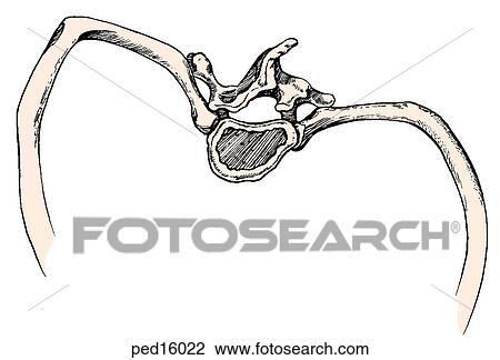 Drawing - Superior view of thoracic cage with thoracic and vertebral changes as noted in right thoracic scoliosis; spinous processes of vertebrae rotate toword midline; as rib attaches to vertebral body it is also rotated; rib is pushed posteriorly on convex side. Fotosearch