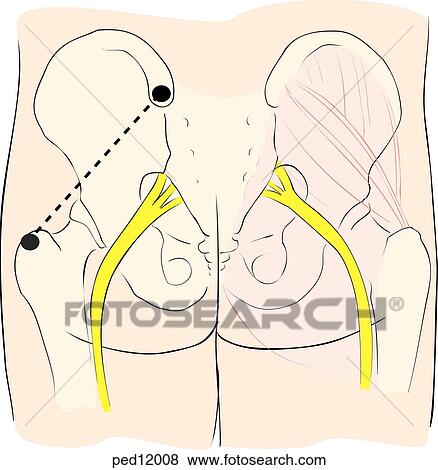 Technique for intramuscular injection in children, dorsogluteal site; illustration shows anatomical landmarks of pelvic region used to locate injection site. View Large Illustration Stock Illustration - Technique for intramuscular injection in children, dorsogluteal site; illustration shows anatomical landmarks of pelvic region used to locate injection site.. Fotosearch