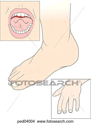 Three images showing typical ulcers of the oral region and eruptions on the hand and feet associated with hand-foot-and-mouth disease. View Large Illustration Stock Illustration - Three images showing typical ulcers of the oral region and eruptions on the hand and feet associated with hand-foot-and-mouth disease.. Fotosearch