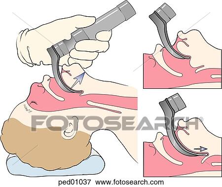Stock Illustration - Three sagittal views of adolescent's head and neck showing direct laryngoscopy using a curved blade; (left) correct positioning of blade in vallecula; (upper right) blade too short, resulting in impingement on midportion of tongue; (lower right) blad. Fotosearch