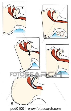 Clip Art - (Top l. ) Upper airway obstruction related to hypotonia; (top r. ) partial relief by head extension; (middle l. ) extreme hyperextension causing upper airway obstruction; (middle r. ) fully open airway through use of jaw thrust; (bottom l. ) oropharyng. Fotosearch