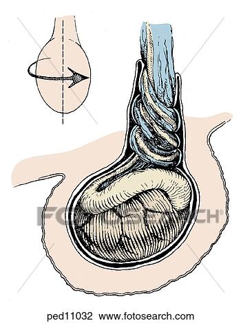 Drawing - Torsion of spermatic vessels as a result of a bell-clapper deformity in the tunica vaginalis.. Fotosearch