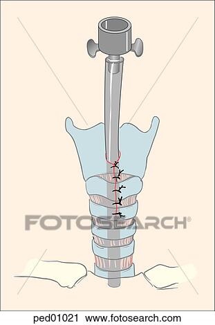 Clip Art - Tracheal tube secured in place.. Fotosearch