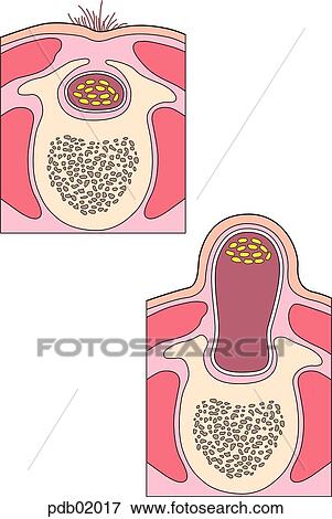 Transection views of normal spine (above) and spina bifida with protrusion of the cord due to fusion failure of vertebral arches. View Large Illustration Stock Illustration - Transection views of normal spine (above) and spina bifida with protrusion of the cord due to fusion failure of vertebral arches.. Fotosearch