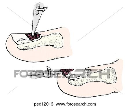 Two procedures for the drainage of subungual hematomas. View Large Illustration Drawing - Two procedures for the drainage of subungual hematomas.. Fotosearch