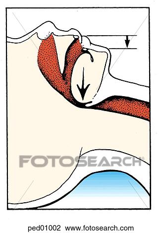 Upper airway obstruction related to hypotonia, mandibular block obstructs airway. View Large Illustration Drawing - Upper airway obstruction related to hypotonia, mandibular block obstructs airway.. Fotosearch