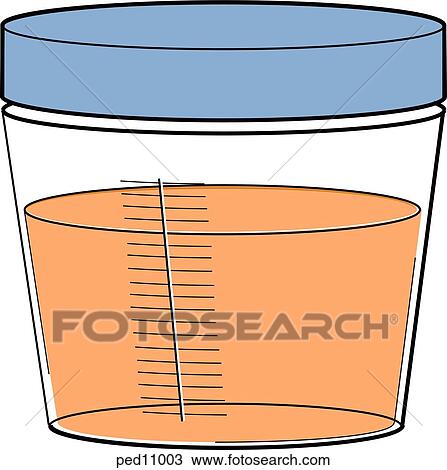 Drawing -  urine collection bottle showing urine tinged with blood.. Fotosearch