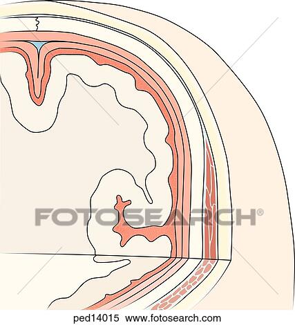 Stock Illustration - Various layers and spaces of the cranium and brain are shown in cutaway; inflamed subarachnoid fluid shown.. Fotosearch