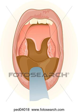 View into mouth showing enlarged tonsils typical of tonsillitis; note white pus patches. View Large Illustration Stock Illustration - View into mouth showing enlarged tonsils typical of tonsillitis; note white pus patches.. Fotosearch