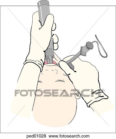 View of child's head showing insertion of endotracheal tube in progress; laryngoscope is still in place; endotracheal tube being inserted from right of midline. View Large Illustration Stock Illustration - View of child's head showing insertion of endotracheal tube in progress; laryngoscope is still in place; endotracheal tube being inserted from right of midline.. Fotosearch