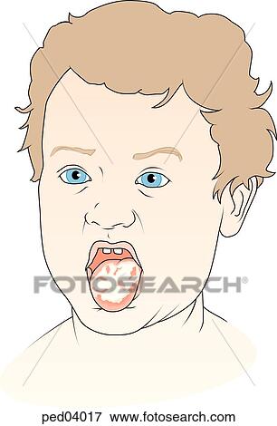 View of young child with protruding white encrusted tongue typical of thrush. View Large Illustration Stock Illustration - View of young child with protruding white encrusted tongue typical of thrush.. Fotosearch