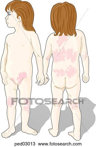 young child showing common areas of eczema. View Large Illustration Drawing - young child showing common areas of eczema.. Fotosearch