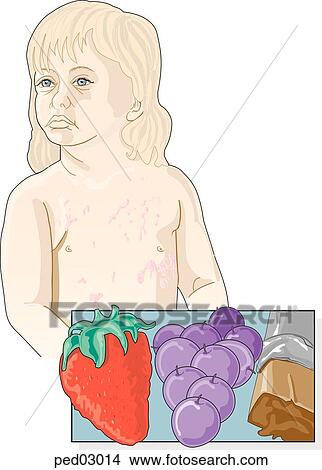 young child showing typical welt-like rashes typical of hives; inset shows some of the foods that can cause such a reaction including strawberries, grapes, and chocolate. View Large Illustration Stock Illustration - young child showing typical welt-like rashes typical of hives; inset shows some of the foods that can cause such a reaction including strawberries, grapes, and chocolate.. Fotosearch