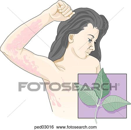 Young girl with arm lifted to show typical poison ivy rash with weepy blisters on underside of arm and wrist; inset shows poison ivy leaflet of three. View Large Illustration Stock Illustration - Young girl with arm lifted to show typical poison ivy rash with weepy blisters on underside of arm and wrist; inset shows poison ivy leaflet of three.. Fotosearch