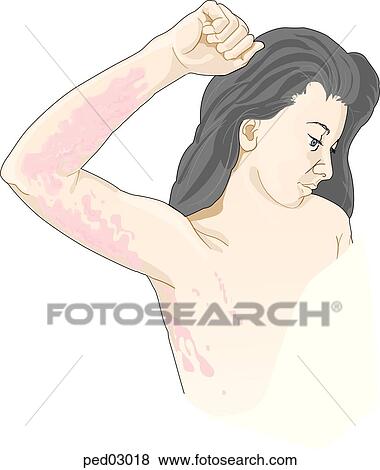 Young girl with arm lifted to show typical poison ivy rash with weepy blisters on underside of arm and wrist. View Large Illustration Stock Illustration - Young girl with arm lifted to show typical poison ivy rash with weepy blisters on underside of arm and wrist.. Fotosearch