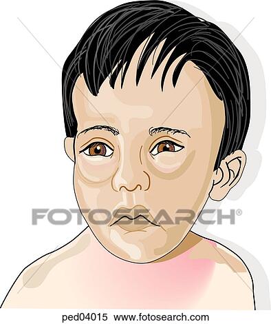 Stock Illustration - Young woman with puffy eyes, typical of sinusitis.. Fotosearch
