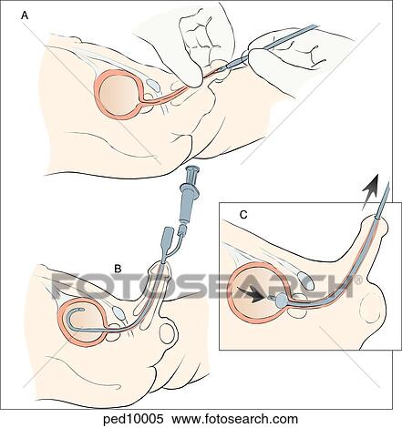 イラスト - 膀胱, カテーテル法, ∥ために∥, boys;, (top), カテーテル, ある, 導入される, ∥で∥, ペニス, 持たれた, 垂直に, へ, suprapubic, 腹部, wall;, (bottom), カテーテル, ある, 十分に, 進んだ, に, 膀胱, 修道院次長, へ, balloon, inflation;, insert:, カテーテル, ある, 撤回される, ゆっくり, へ, ロッジ, a. Fotosearch