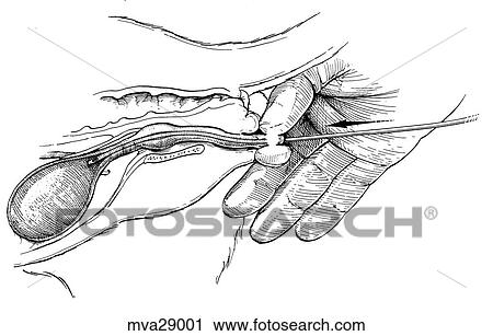 Catheterization, male feline View Large Illustration Clip Art - Catheterization, male feline. Fotosearch