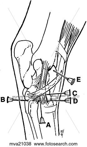 Hock joint, equine View Large Illustration Stock Illustration - Hock joint, equine. Fotosearch
