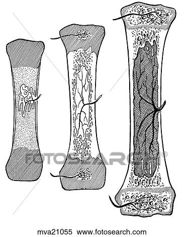 Stock Illustration - Ossification of a developing bone, equine. Fotosearch