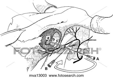 Peterson eye block, bovine View Large Illustration Drawing - Peterson eye block, bovine. Fotosearch