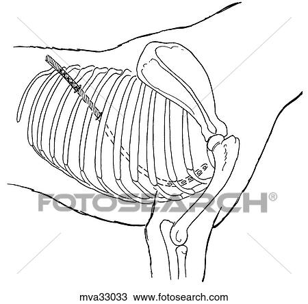 Drawing - Thoracostomy tube, placement, canine. Fotosearch