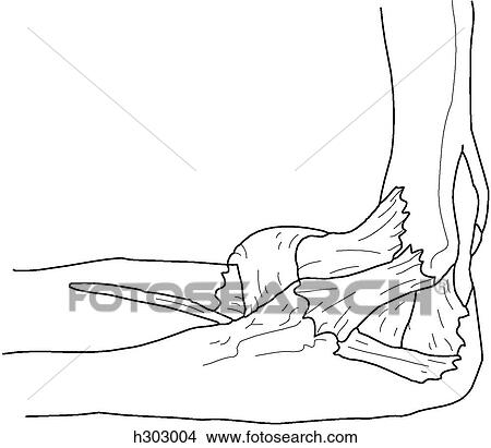 Bones & ligaments of elbow View Large Illustration Stock Illustration - Bones & ligaments of elbow. Fotosearch
