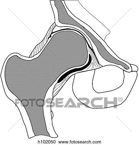 Clipart - Hip joint, cross section. Fotosearch