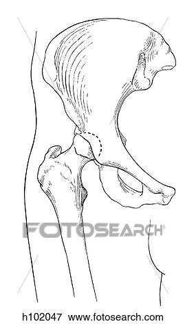 Stock Illustration - Hip joint. Fotosearch