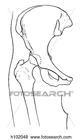 Stock Illustration - Hip joint. Fotosearch