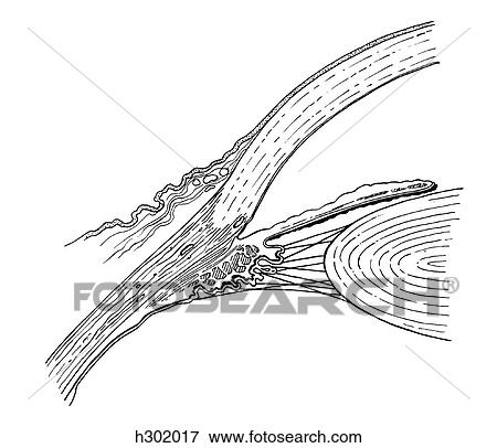 Iridocorneal angle View Large Illustration Stock Illustration - Iridocorneal angle. Fotosearch