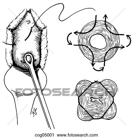 Истмико корпоральный разрез на матке рисунок