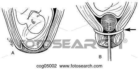 Drawing - Cervical cerclage, Orr technique. Fotosearch