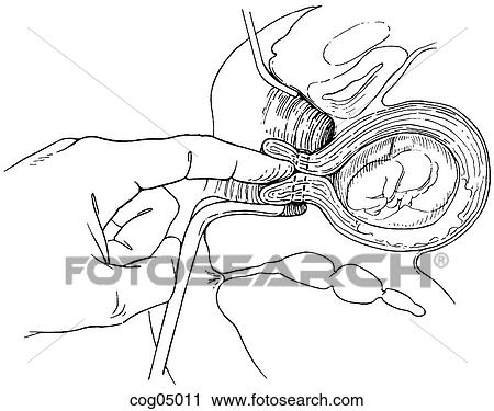 Clip Art - Cervical cerclage, Shirodkar-Barter techn., part 7. Fotosearch