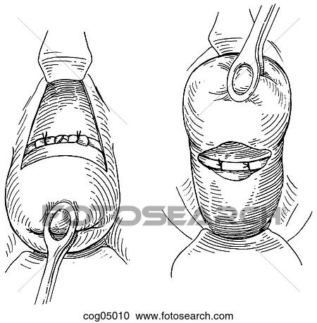 Clipart - Cervical cerclage, Shirodkar-Barter techn., part 6. Fotosearch