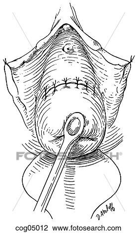 Cervical cerclage, Shirodkar-Barter techn., part 8 View Large Illustration Drawing - Cervical cerclage, Shirodkar-Barter techn., part 8. Fotosearch