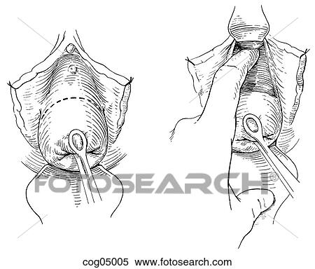 Stock Illustration - Cervical cerclage, Shirodkar-Barter techn., part 1. Fotosearch