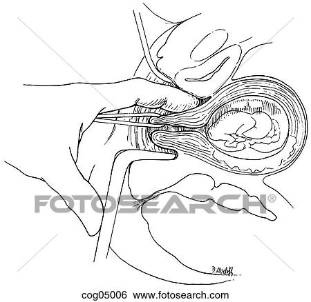 Stock Illustration - Cervical cerclage, Shirodkar-Barter techn., part 2. Fotosearch