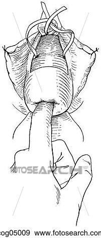 Stock Illustration - Cervical cerclage, Shirodkar-Barter techn., part 5. Fotosearch