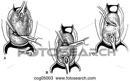 Drawing - Cervical cerclage, Shirodkar technique, step 1. Fotosearch