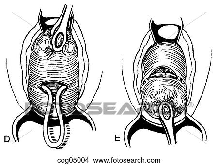 Cervical cerclage, Shirodkar technique, step 2 View Large Illustration Stock Illustration - Cervical cerclage, Shirodkar technique, step 2. Fotosearch