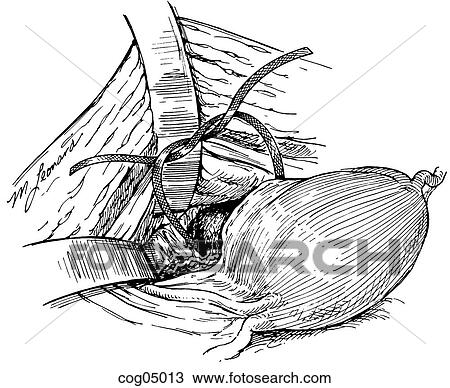 Drawing - Cervical cerclage, transabdominal. Fotosearch