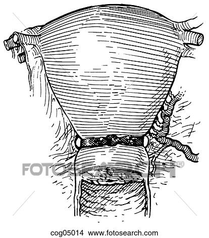 Stock Illustration - Cervical cerclage, transabdominal. Fotosearch